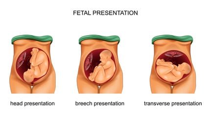 pregnancy complications
