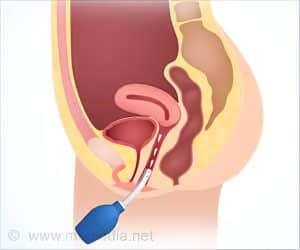 Douching (bacterial vaginosis)