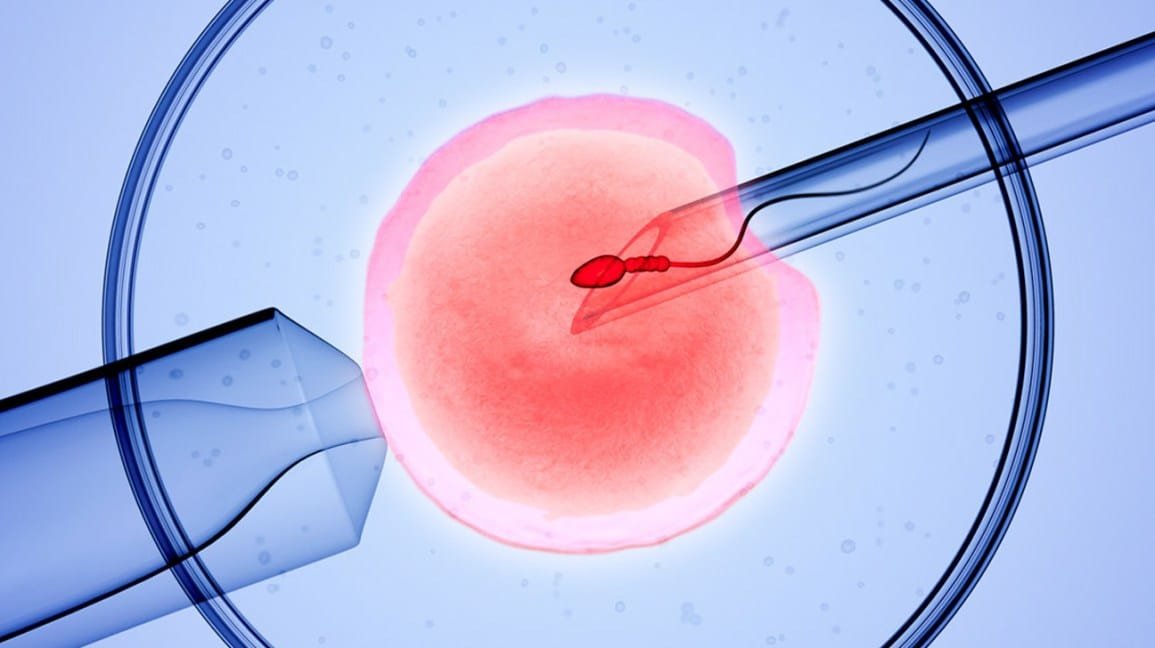 In Vitro Fertilization