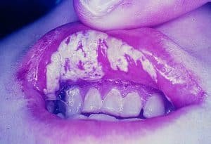 Vaginitis (Invasive Candidiasis)