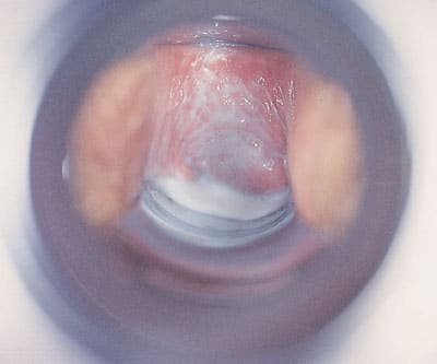 bacterial vaginosis
