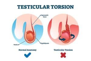 Testicular Torsion