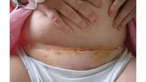 Hysterectomy
