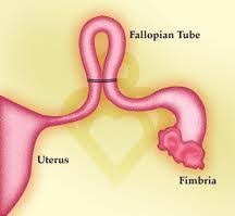 Tubal ligation