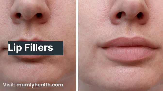 Lip Fillers